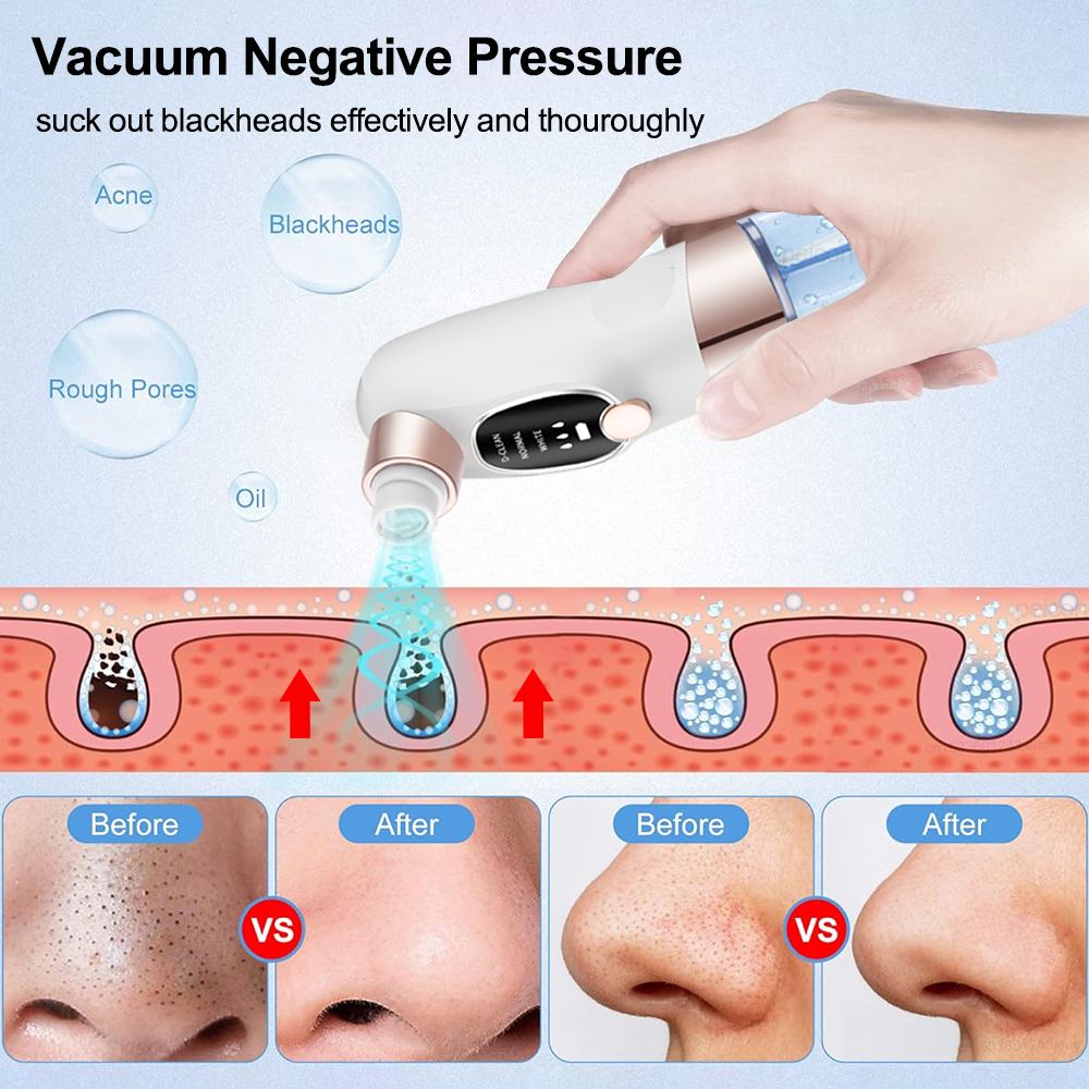 Blackhead Remover Electric Bla - Air Bubble Remover 评论和价格